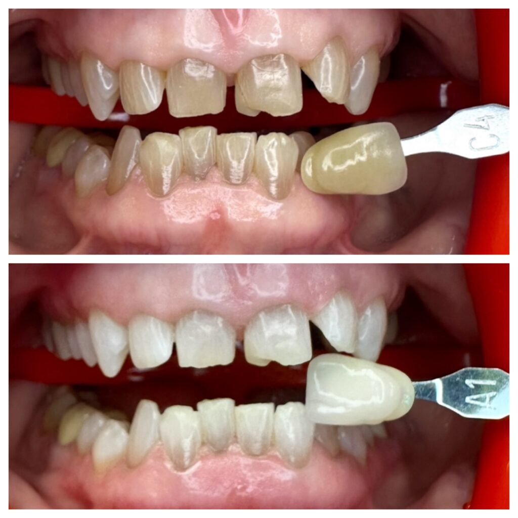Before and after KöR Whitening showing brighter teeth and reduced discoloration