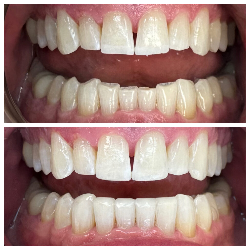 Before and after crown lengthening reshaping the gum line to reveal more natural tooth structure
