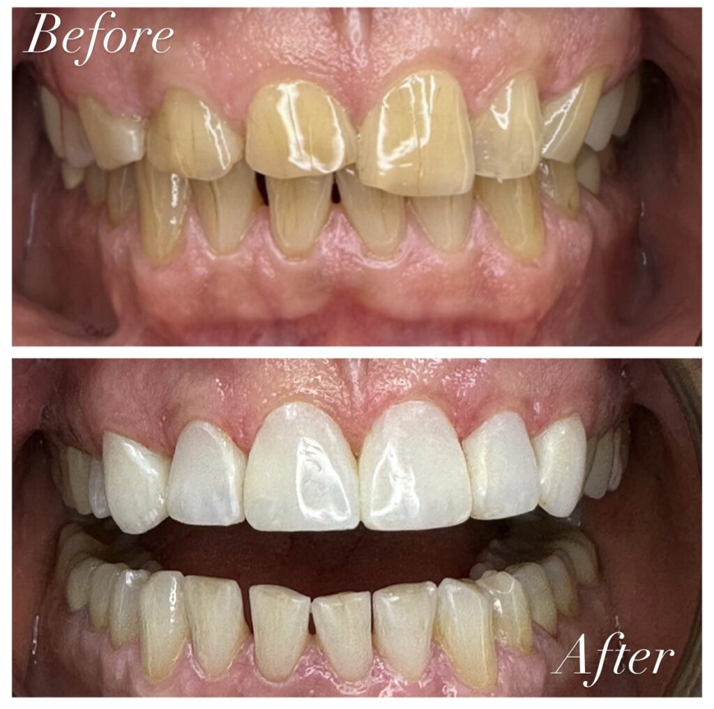Before and after composite veneers improving tooth color, shape, and smile symmetry