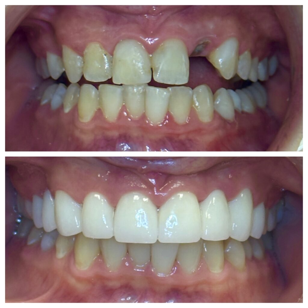 Before and after dental treatment repairing a broken tooth and improving smile alignment