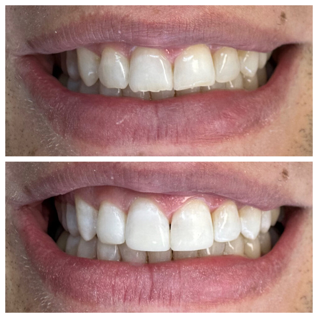 Before and after smile makeover improving tooth shape, color, and overall smile harmony
