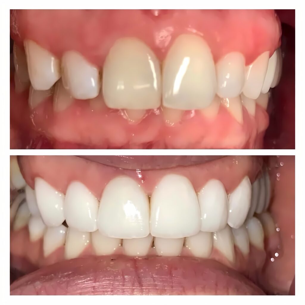 Before and after gum lift reshaping the gum line to improve tooth proportions