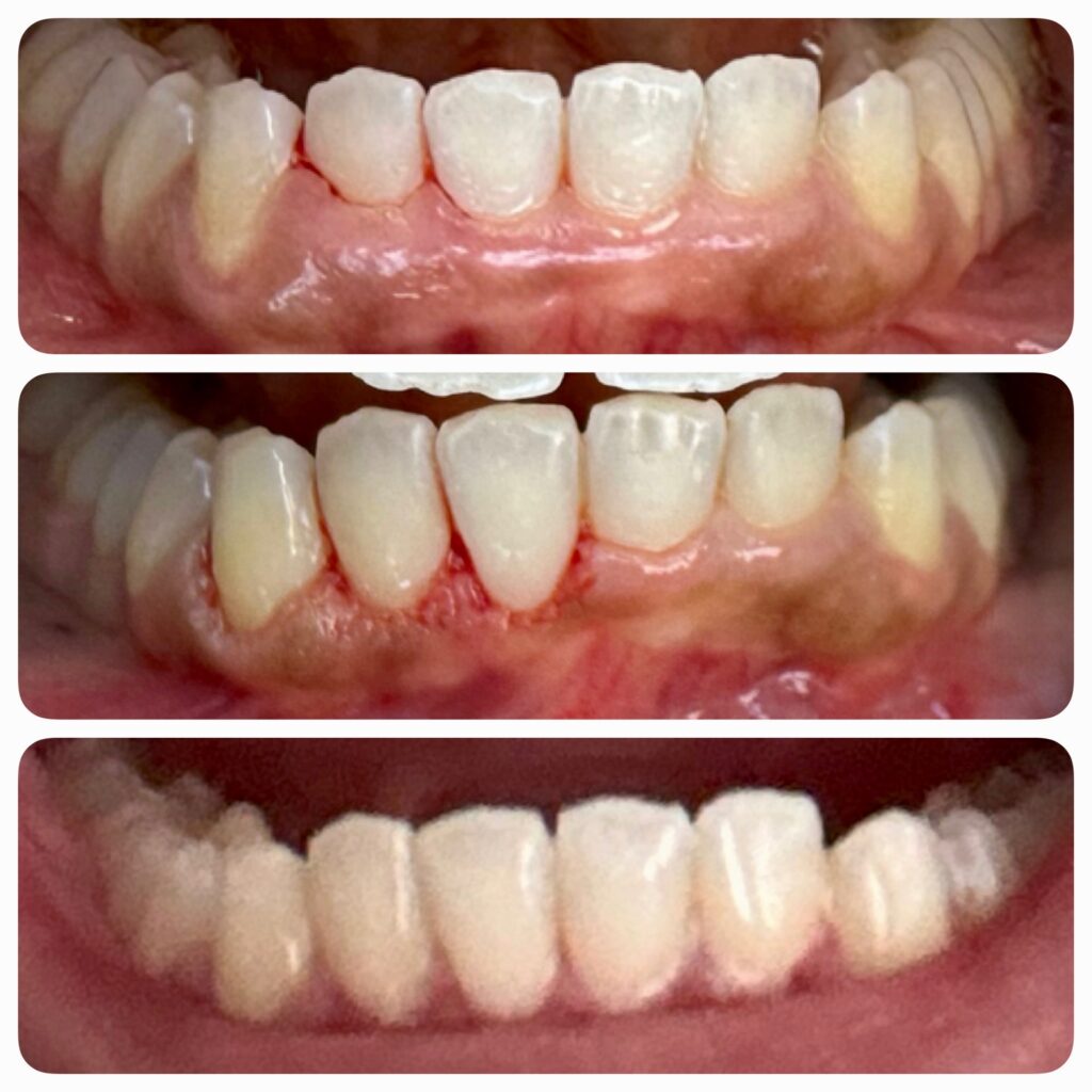 Before and after lower bonding to restore tooth shape and function
