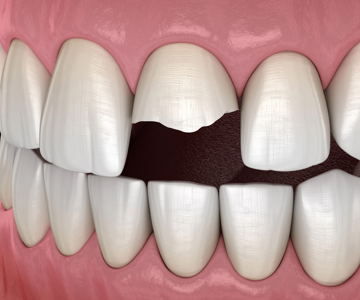 Cracked tooth illustration showing damaged front teeth