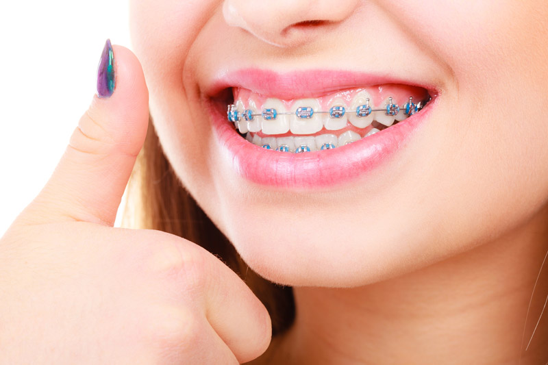 Close-up of patient smiling with braces showing straight teeth