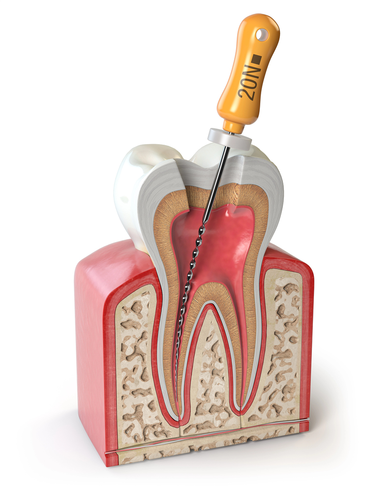 Dental root canal procedure illustration showing infected tooth
