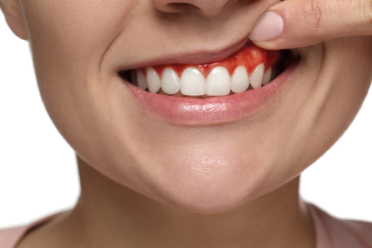 Gum disease illustration showing inflamed gums